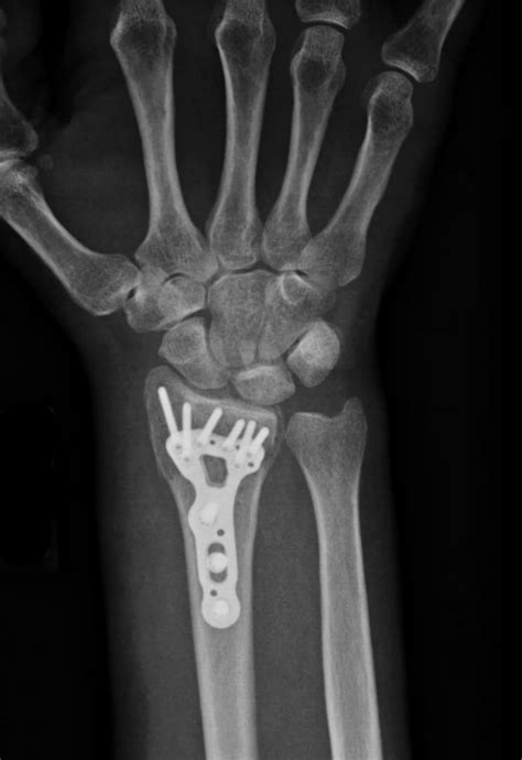 . . Wrist stiffness after distal radius fracture